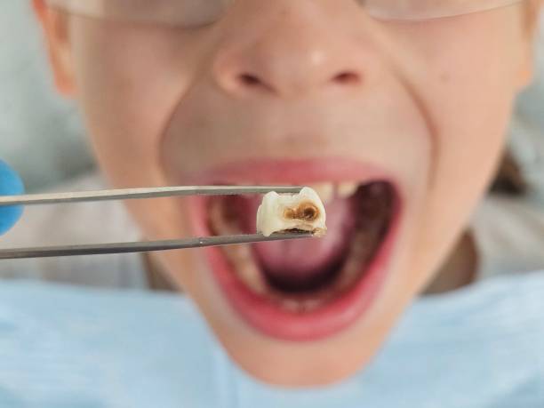Best Dentist for Tooth Abscess  in Gleneagle, CO